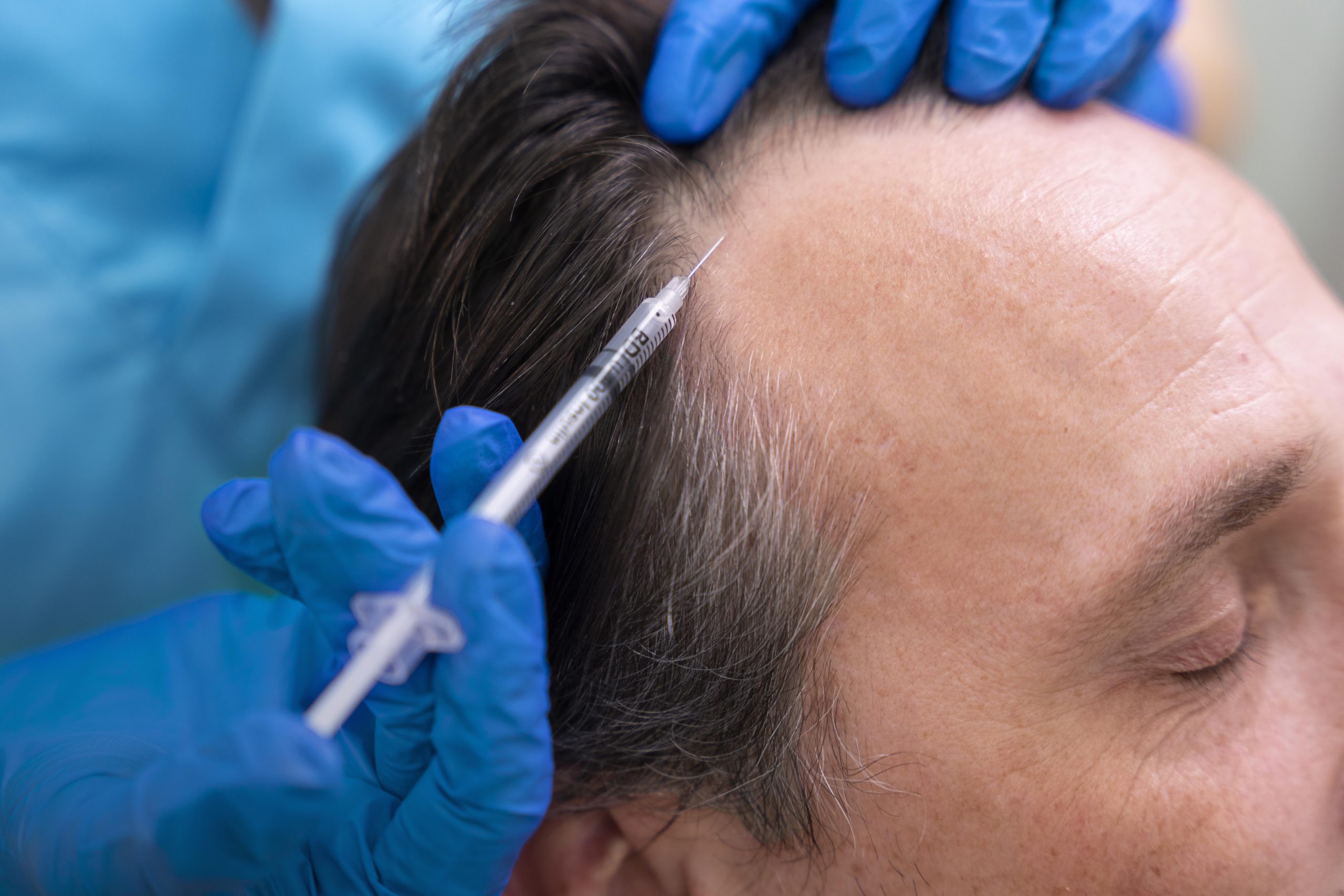 Advanced hair restoration treatment at VitaRevo