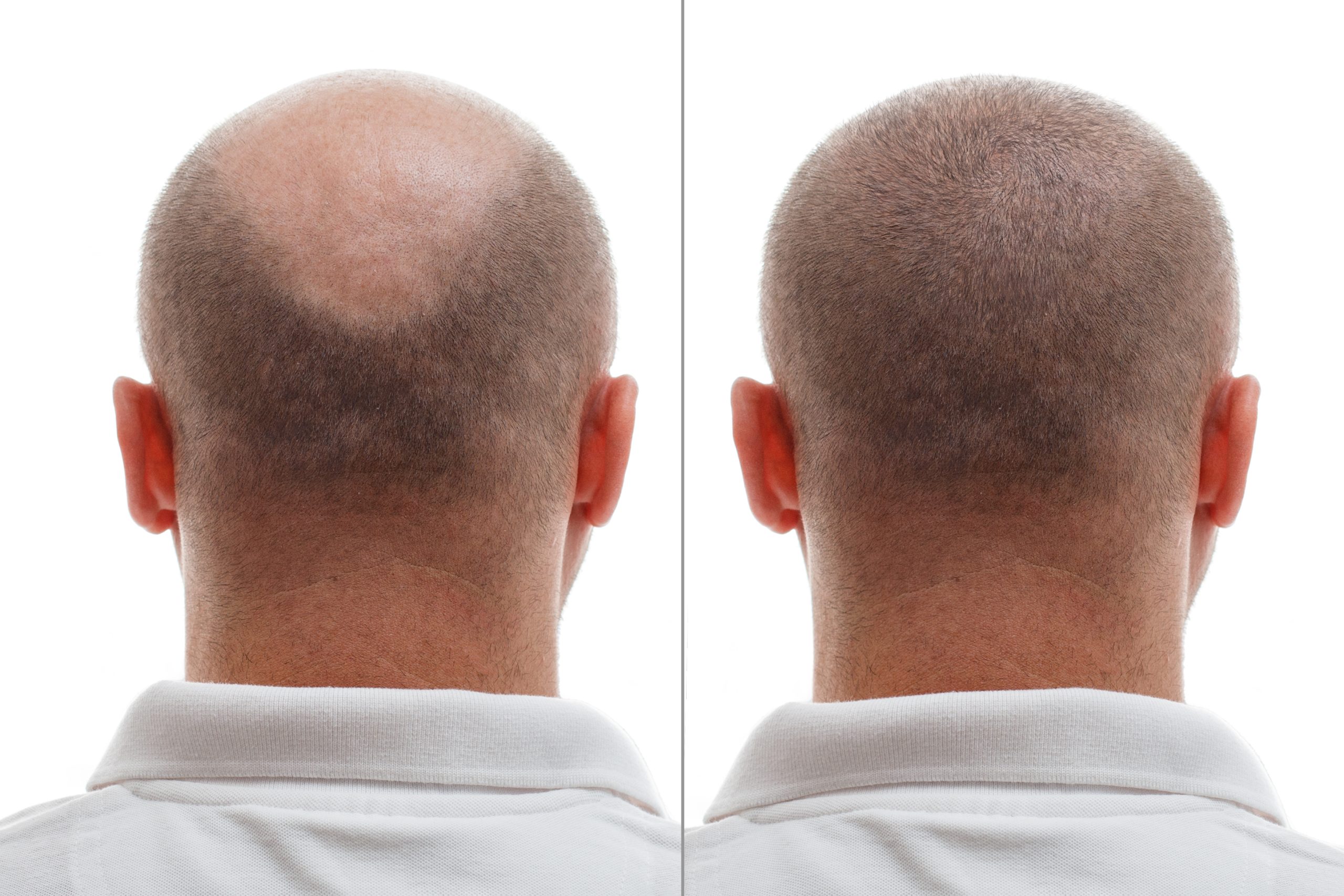 Hair restoration before and after results