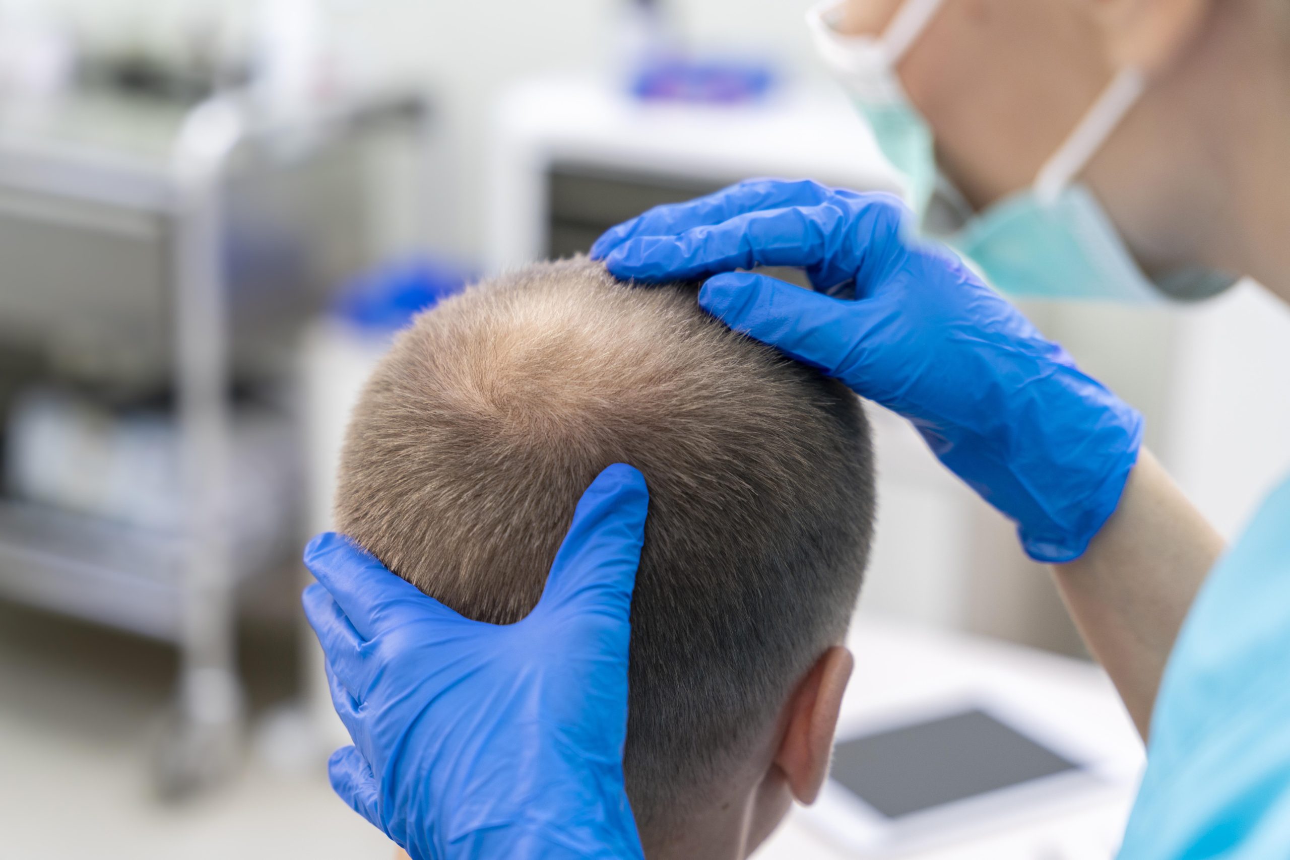Man experiencing hair thinning and hair loss